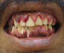 Gum swelling