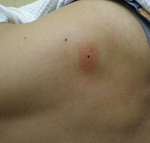 Bone marrow sampling site after the procedure