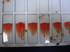 Prepared bone marrow aspirate slides