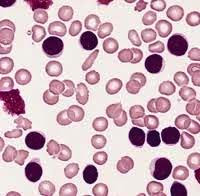 CLL cells