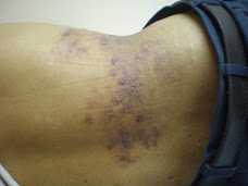 Shingles