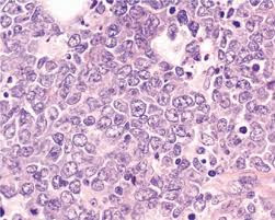 DLBCL histology