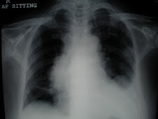 Pleural fluid