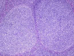 Follicular lymphoma
