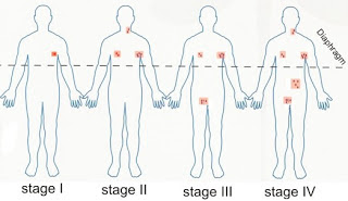 Lymphoma stages