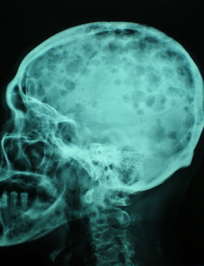 Skull lytic lesions