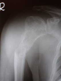 Bone fracture