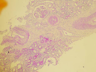 Renal biopsy