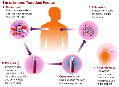 Autologous transplant