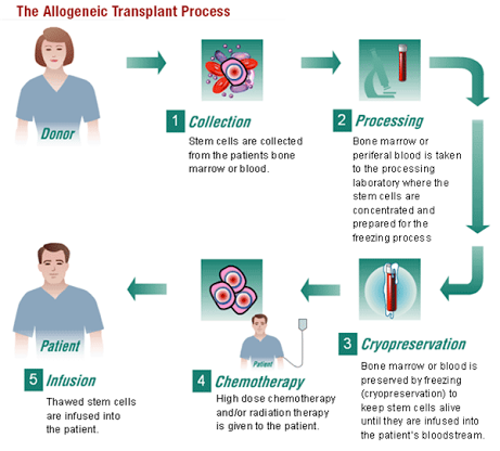 Allogeneic transplant