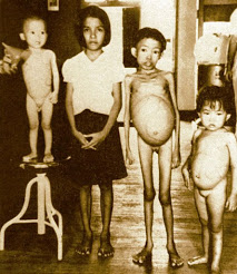 Thalassaemia