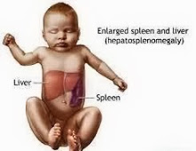 Hepatosplenomegaly