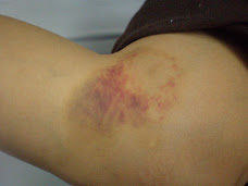 Easy bruising