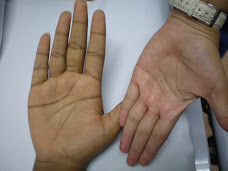 Anaemia - pale palms