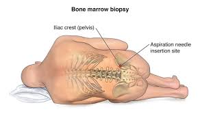 Bone marrow aspirate slides