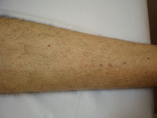 Low platelet bleeding