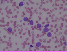 Leukaemic cells